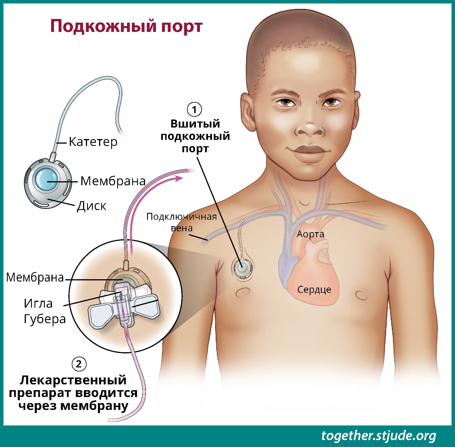 Подкожная порт-система